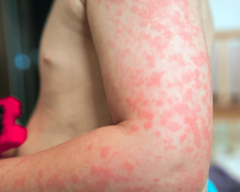 Reacción alergica a una alergia alimentaria